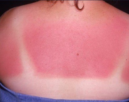 Horse rider showing sunburn